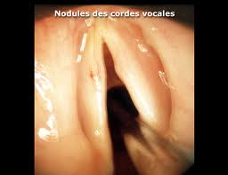 nodules1